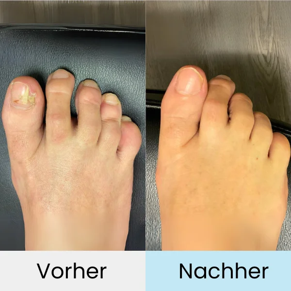 Nagelpilz Lasertherapie VitaNail