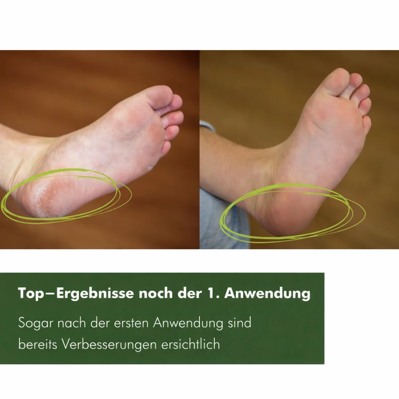 HornhautSanft Pflegepaket