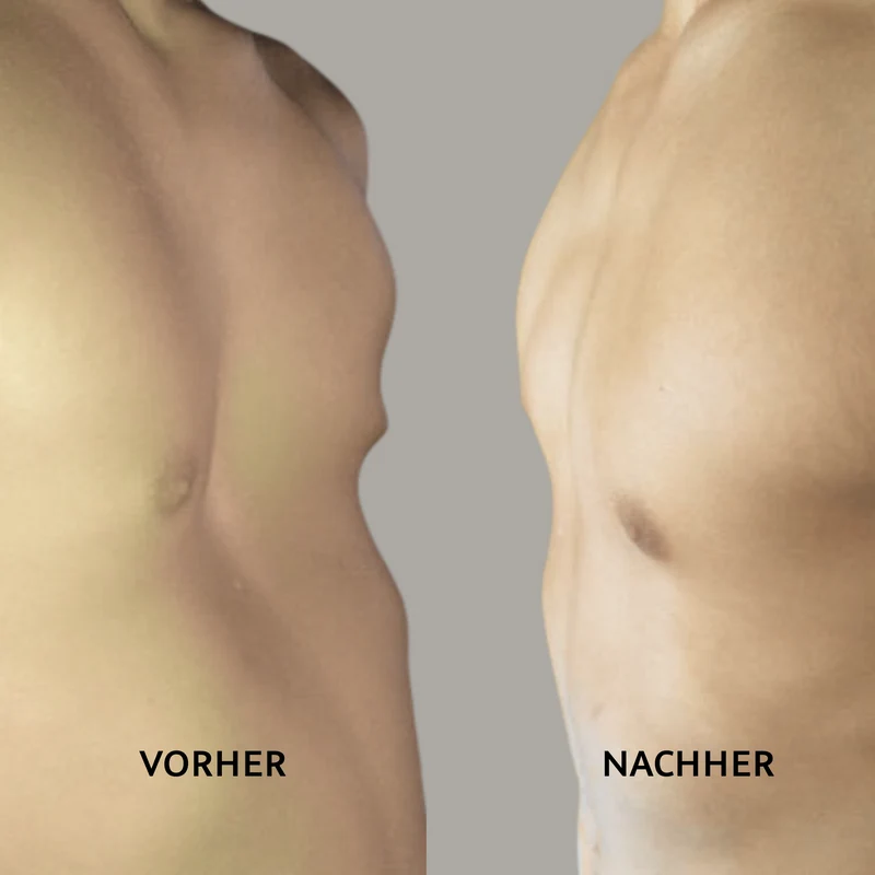 Saugglocke nach Eckard Klobe - Preis auf Anfrage*