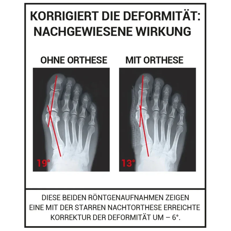 EPITACT® Hallux Valgus Korrekturbandage für die Nacht