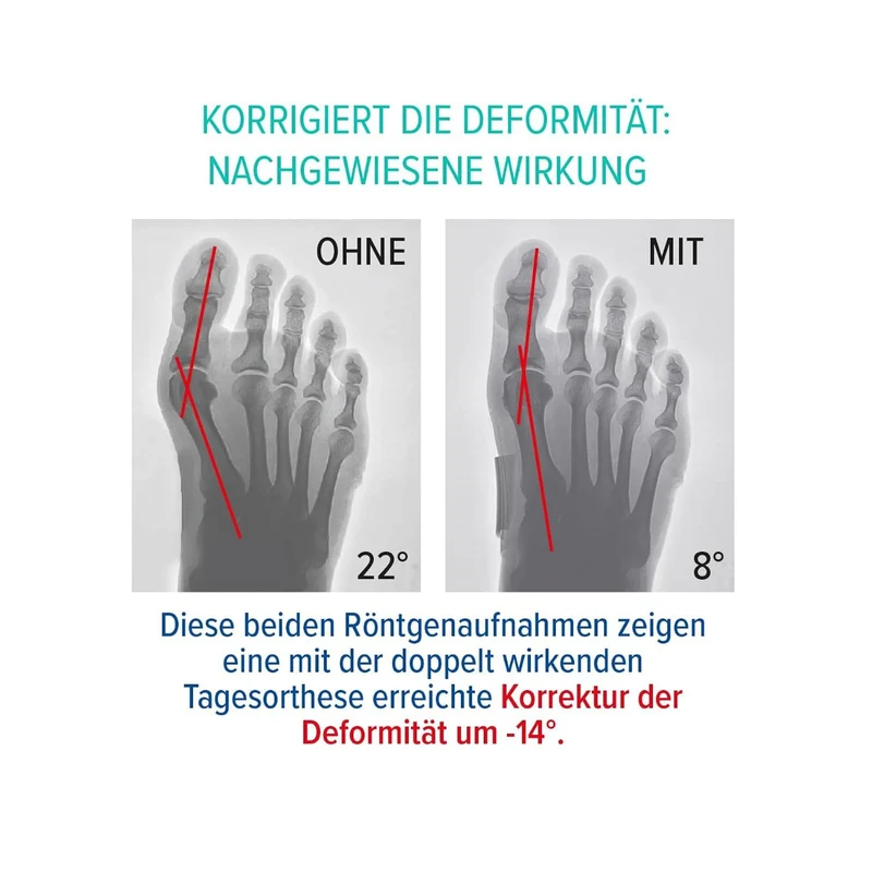 EPITACT® Flexible Korrekturbandage für den Tag