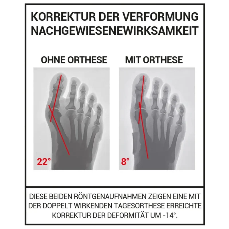 EPITACT® flexible Doppelschutz-Korrekturbandage